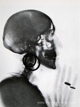 Radiographie du crâne de M.O.